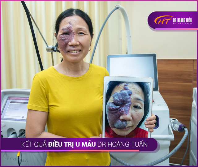 Niềm vui của nữ khách hàng được tài trợ 100% chi phí điều trị u máu khổng lồ.